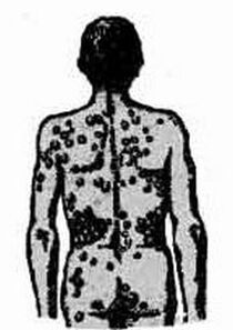 A schema of possible infection